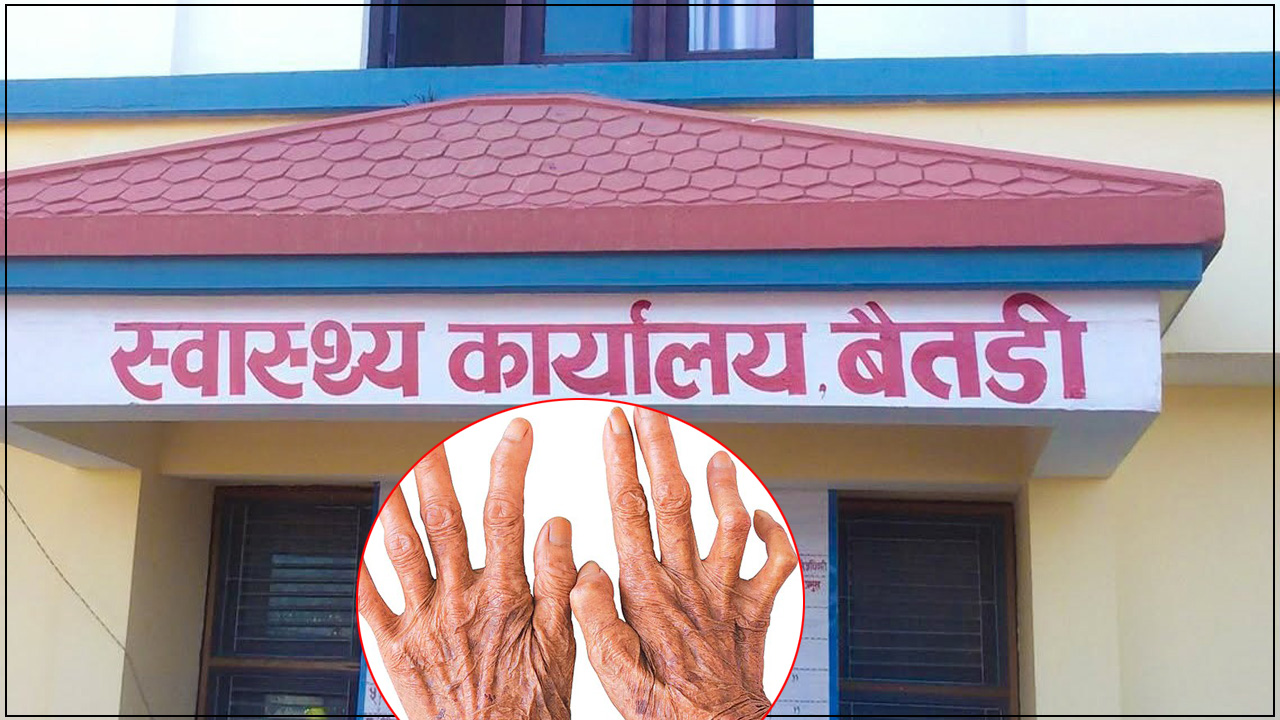 बैतडीमा तीन वर्षको अवधिमा १६ जनामा कुष्ठरोग